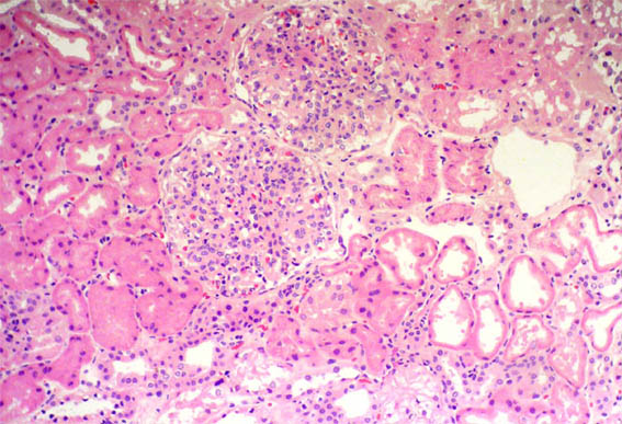 Nephritic nephrotic Syndrome